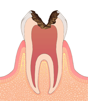 虫歯進行C3
